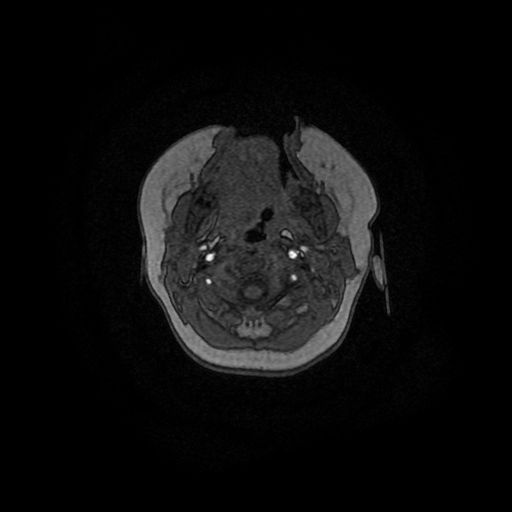 Acute phase of hemiconvulsion-hemiplegia epilepsy syndrome (Radiopaedia 29309-29745 Axial TOF angiography 171).jpg