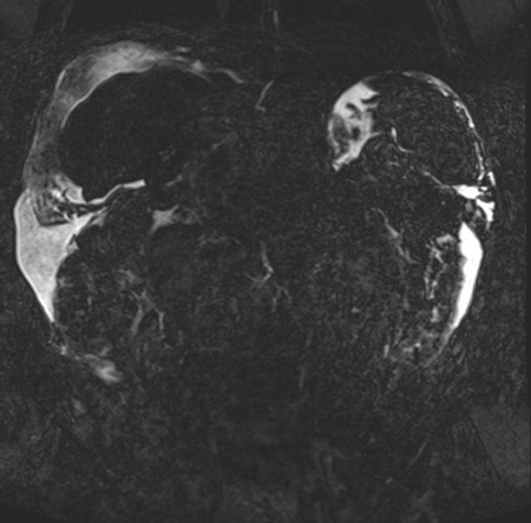Acute portal vein thrombosis (Radiopaedia 73198-83925 Coronal Heavily T2 thin cuts 57).jpg