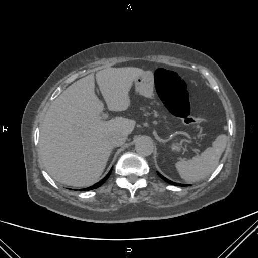 Acute renal artery occlusion (Radiopaedia 86586-102682 Axial non-contrast 14).jpg
