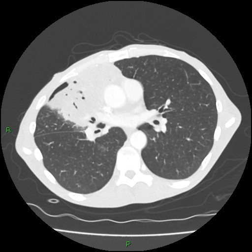Acute right lung abscess (Radiopaedia 34806-36258 Axial lung window 98).jpg