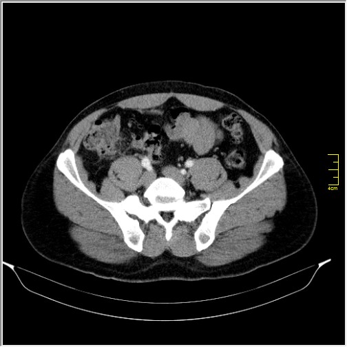 File:Acute right sided diverticulitis (Radiopaedia 65249-74268 Axial C+ portal venous phase 57).JPG