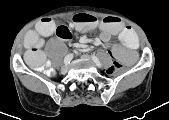 Acute small bowel (ileal) volvulus (Radiopaedia 71740-82139 Axial C+ portal venous phase 138).jpg