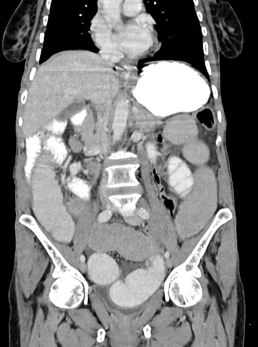 Acute small bowel (ileal) volvulus (Radiopaedia 71740-82139 Coronal C+ portal venous phase 57).jpg