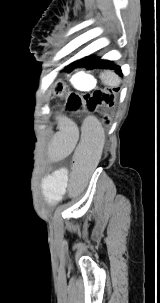 Acute small bowel (ileal) volvulus (Radiopaedia 71740-82139 Sagittal C+ portal venous phase 33).jpg