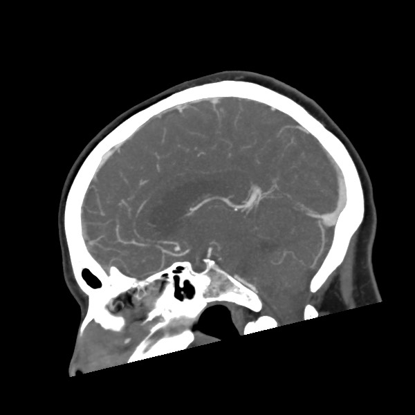 Acute subarachnoid hemorrhage and accessory anterior cerebral artery (Radiopaedia 69231-79009 Sagittal C+ arterial phase 39).jpg