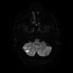Acute superior cerebellar artery territory infarct (Radiopaedia 84104-99358 Axial DWI 60).jpg