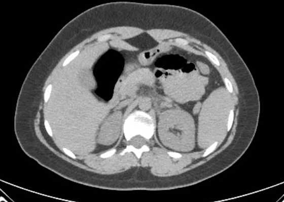 Acute unilateral nonhemorrhagic adrenal infarction (Radiopaedia 67560-76957 Axial non-contrast 40).jpg