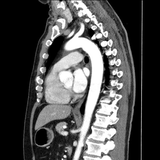 Adenocarcinoma of the lung (Radiopaedia 59871-67325 Sagittal C+ arterial phase 57).jpg