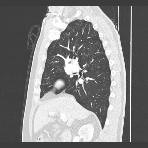 Adenocarcinoma of the lung (Radiopaedia 59871-67325 Sagittal lung window 37).jpg