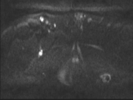 Adenocarcioma of rectum- T1 lesion (Radiopaedia 36921-38546 Axial DWI 33).png