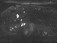 Adenocarcioma of rectum- T1 lesion (Radiopaedia 36921-38546 Axial DWI 36).png