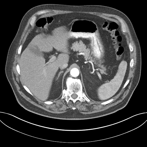 Adenocarcioma of rectum- T1 lesion (Radiopaedia 36921-38547 Axial C+ arterial phase 55).png