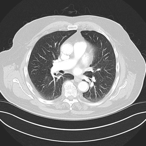 Adenocarcioma of rectum- T1 lesion (Radiopaedia 36921-38547 Axial lung window 29).png