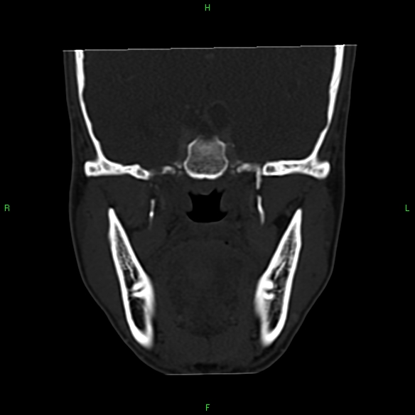 File:Adenoid cystic carcinoma of hard palate (Radiopaedia 26137-26273 Coronal bone window 18).jpg