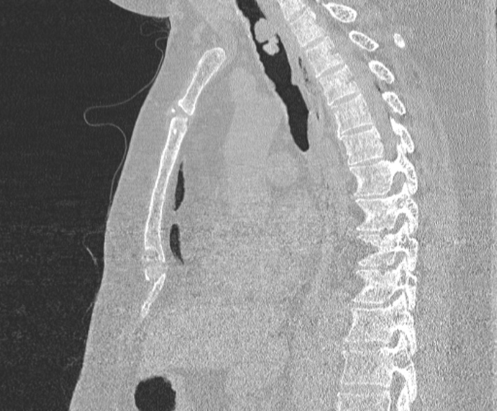 Adenoid cystic carcinoma of the trachea (Radiopaedia 49042-54137 Sagittal lung window 246).jpg