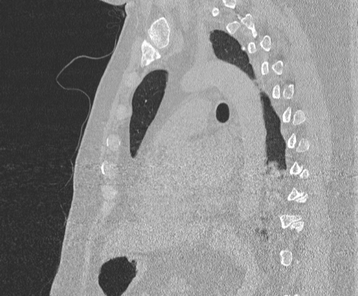 Adenoid cystic carcinoma of the trachea (Radiopaedia 49042-54137 Sagittal lung window 272).jpg
