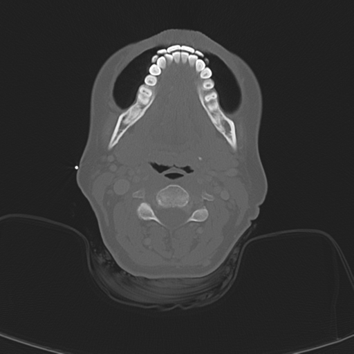 Adenoid cystic tumor of palate (Radiopaedia 46980-51518 Axial bone window 38).png