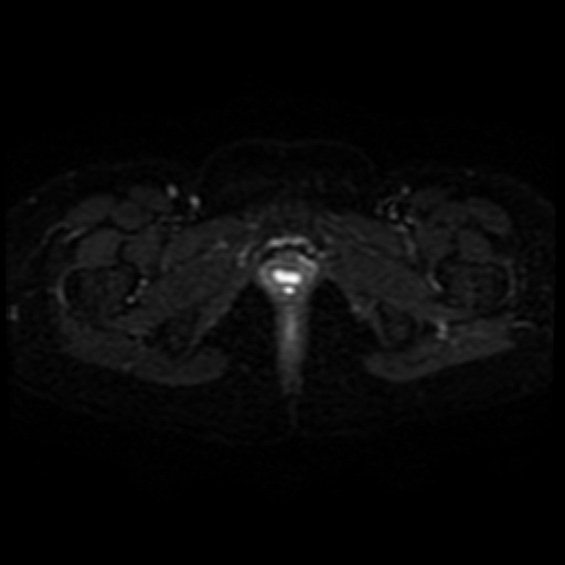Adenoma malignum of cervix (Radiopaedia 66441-75705 Axial DWI 22).jpg