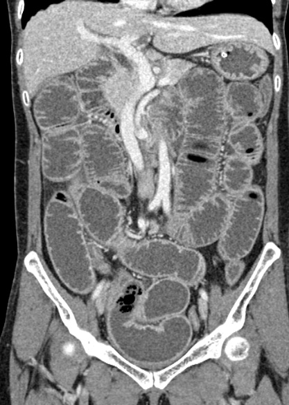 Adhesional small bowel obstruction (Radiopaedia 48397-53305 Coronal C+ portal venous phase 154).jpg