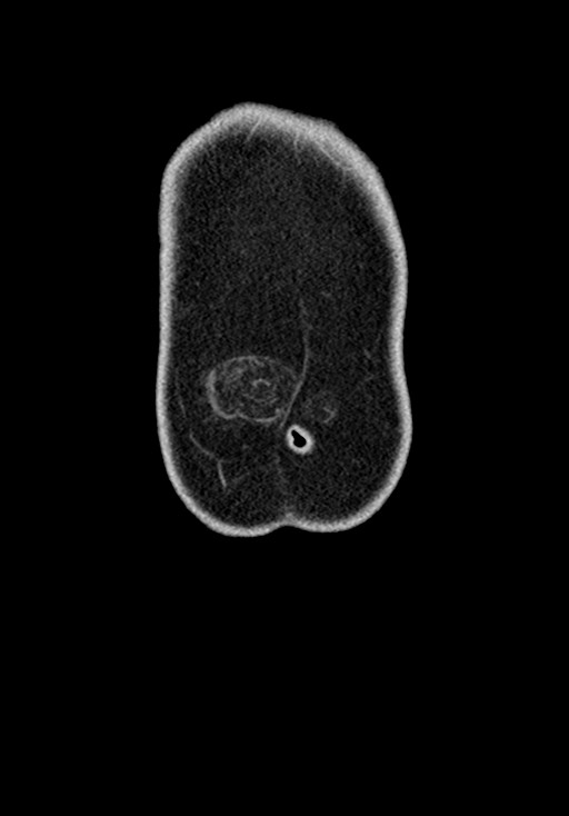 Adhesional small bowel obstruction (Radiopaedia 58900-66131 Coronal C+ portal venous phase 47).jpg