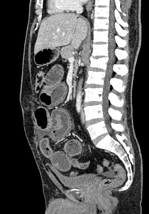 Adhesional small bowel obstruction (Radiopaedia 58900-66131 Sagittal C+ portal venous phase 125).jpg