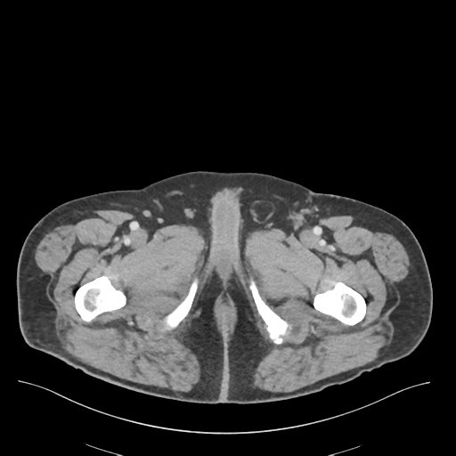 Adhesions within abdominal wall hernia (Radiopaedia 58283-65394 Axial C+ portal venous phase 93).png
