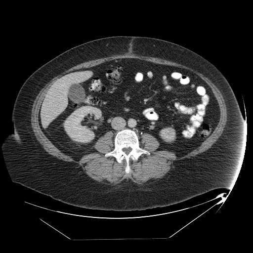 Adrenal angiosarcoma (Radiopaedia 81081-94671 Axial C+ portal venous phase 45).jpg