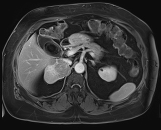Adrenal cortical carcinoma (Radiopaedia 64017-72770 J 30).jpg