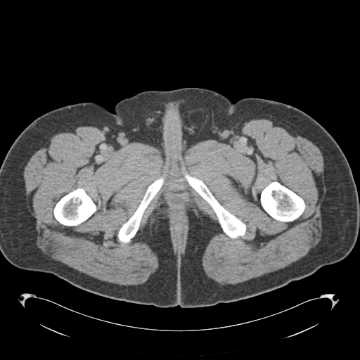 Adrenal cyst (Radiopaedia 45625-49776 Axial C+ portal venous phase 106).png