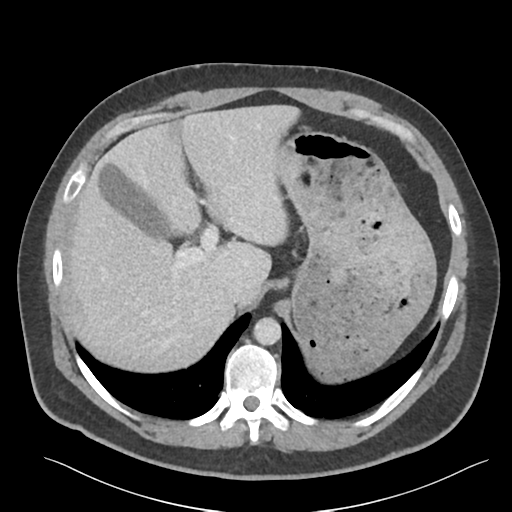 File:Adrenal cyst (Radiopaedia 45625-49777 Axial C+ portal venous phase 25).png