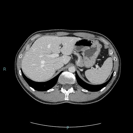Adrenal cystic lymphangioma (Radiopaedia 83161-97534 Axial C+ portal venous phase 24).jpg
