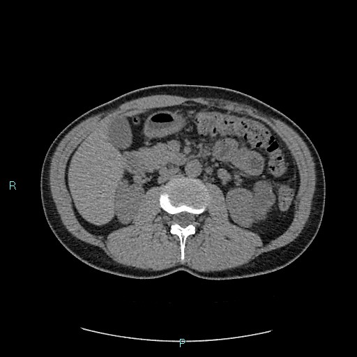 File:Adrenal cystic lymphangioma (Radiopaedia 83161-97534 Axial non-contrast 40).jpg
