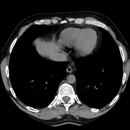 Adrenal gland trauma (Radiopaedia 81351-95079 Axial non-contrast 6).jpg