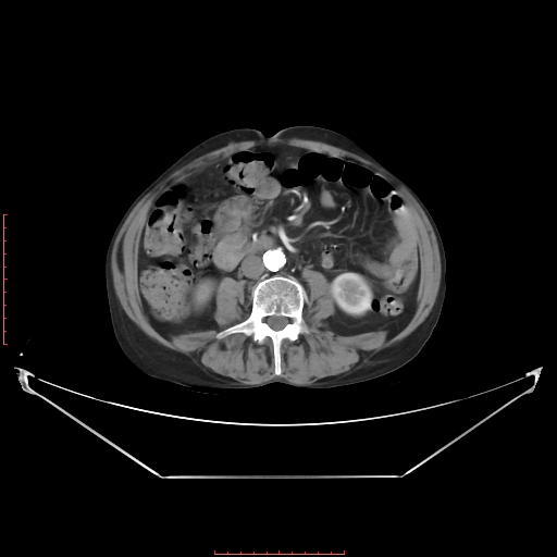 Adrenal hemangioma (Radiopaedia 68923-78668 Axial C+ arterial phase 42).jpg