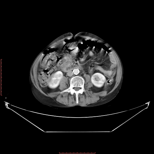 File:Adrenal hemangioma (Radiopaedia 68923-78668 Axial C+ portal venous phase 40).jpg