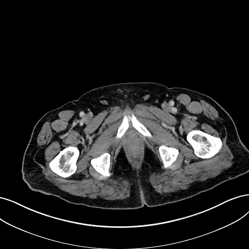 File:Adrenal lymphoma (Radiopaedia 73730-84529 Axial C+ portal venous phase 134).jpg