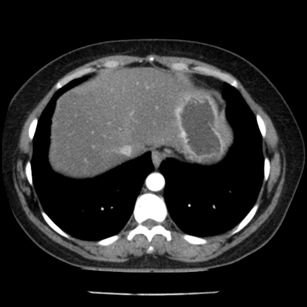 Adrenal myelolipoma (Radiopaedia 43401-46759 Axial C+ arterial phase 10).jpg