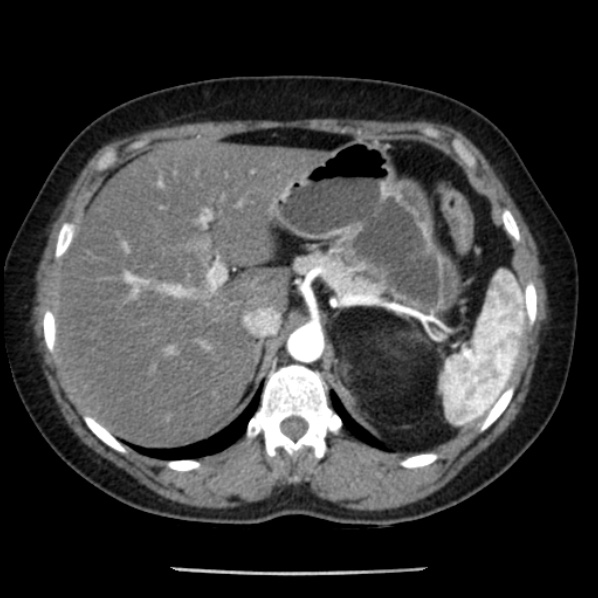 Adrenal myelolipoma (Radiopaedia 43401-46759 Axial C+ arterial phase 24).jpg