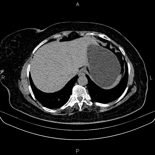 Adrenal myelolipoma (Radiopaedia 82742-96986 Axial non-contrast 16).jpg