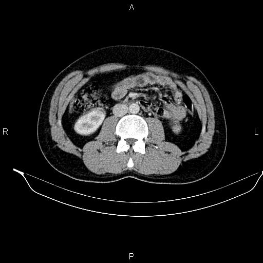 File:Adrenal myelolipoma (Radiopaedia 87794-104246 Axial renal cortical phase 54).jpg