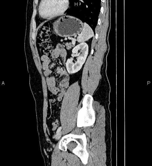 Adrenal myelolipoma (Radiopaedia 87794-104246 Sagittal renal cortical phase 68).jpg