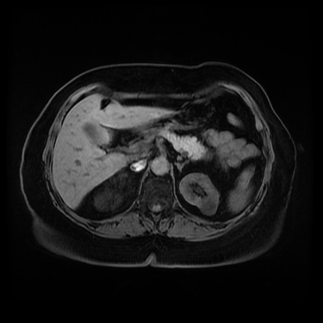 Adrenal myelolipoma - MRI (Radiopaedia 83249-97646 Axial T1 fat sat 29).jpg