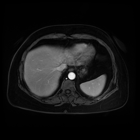 Adrenal myelolipoma - MRI (Radiopaedia 83249-97646 T1 fat sat arterial phase 7).jpg