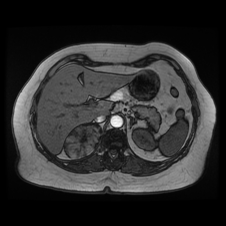 File:Adrenal myelolipoma - MRI (Radiopaedia 83249-97646 T1 out-of-phase 7).jpg