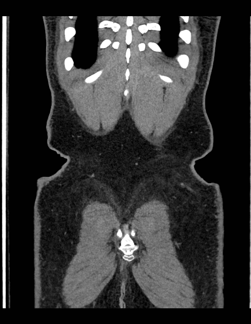 Adrenal myelolipoma - bilateral (Radiopaedia 74805-85810 Coronal C+ portal venous phase 54).jpg