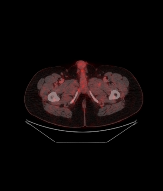 Adrenocortical carcinoma (Radiopaedia 80134-93440 ِAxial 267).jpg