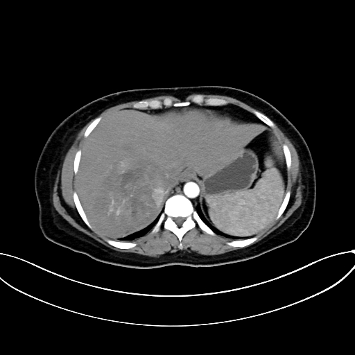Adrenocortical carcinoma (Radiopaedia 87281-103569 Axial C+ arterial phase 16).jpg