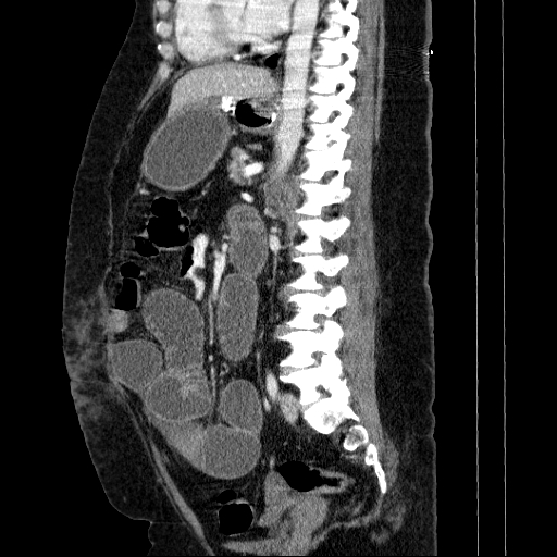 Afferent loop syndrome - secondary to incarcerated trocar site hernia (Radiopaedia 82959-97305 Sagittal C+ portal venous phase 68).jpg