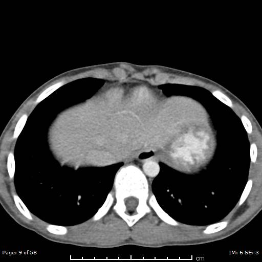File:Agenesis of the gallbladder (Radiopaedia 55454-61905 Axial 43).jpg