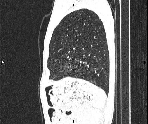 Air bronchogram in pneumonia (Radiopaedia 85719-101512 Sagittal lung window 78).jpg